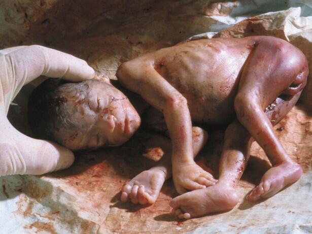 Stop Aborsi Pengertian, Akibat dan Hukumnya &#91;Disertai Foto Bayi Hasil Aborsi&#93;