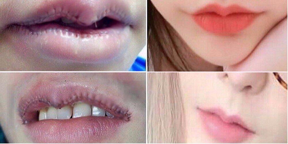 &#91;GATSUONE INFO&#93; Tren Baru, Operasi Penipisan Bibir yang Marak di Kalangan Wanita Asia