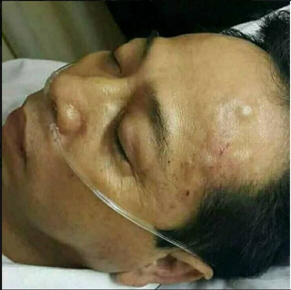 Soal Benjol Bakpao Setya Novanto, Pengacara: Masih Diperban