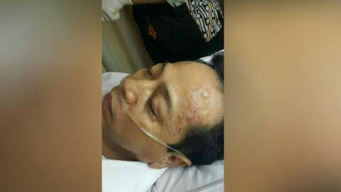Ini Penampakan &quot;Benjol Bakpao&quot; Setya Novanto