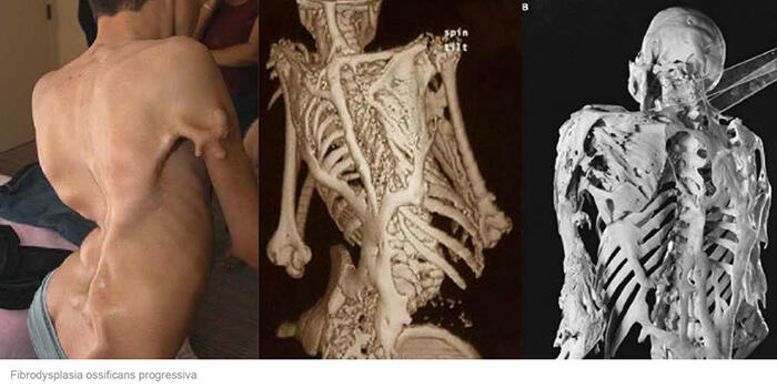 Mengenal Penyakit Fibrodysplasia Ossificans Progressiva (FOP), Sindrom Manusia Batu!!