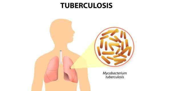 &#91;HBD2FORSIS&#93; Kenapa Sih Sista Mesti Peduli Tuberkulosis?