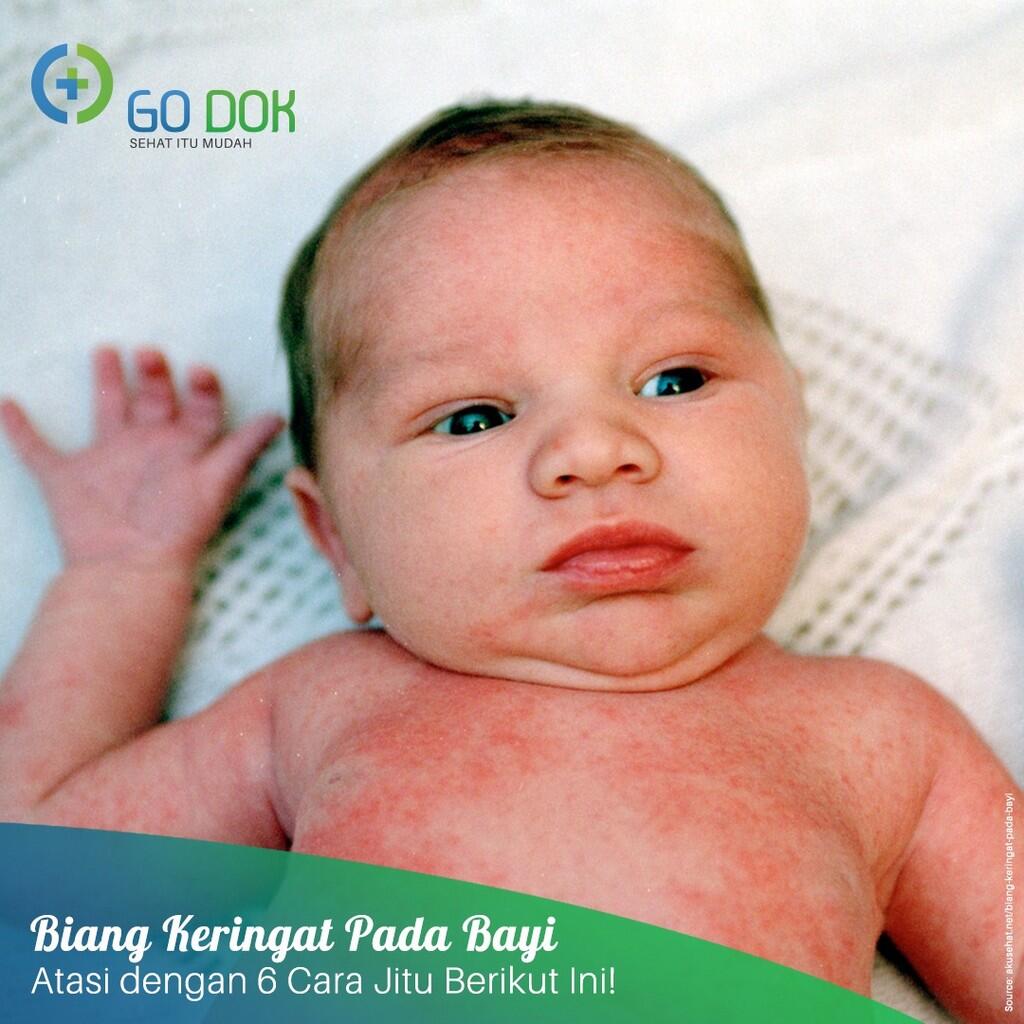 Atasi Biang Keringat Pada Bayi dengan 6 Cara Jitu Berikut Ini!