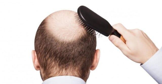 Ini Obatnya Untuk Kaskuser Yang Punya Masalah Kebotakan &amp; Kerontokan Rambut