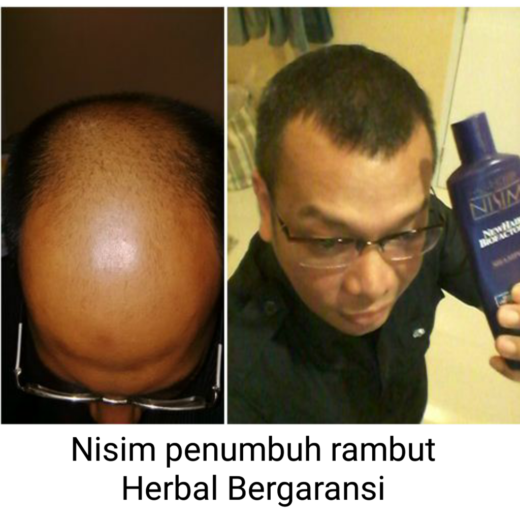 Ini Obatnya Untuk Kaskuser Yang Punya Masalah Kebotakan &amp; Kerontokan Rambut