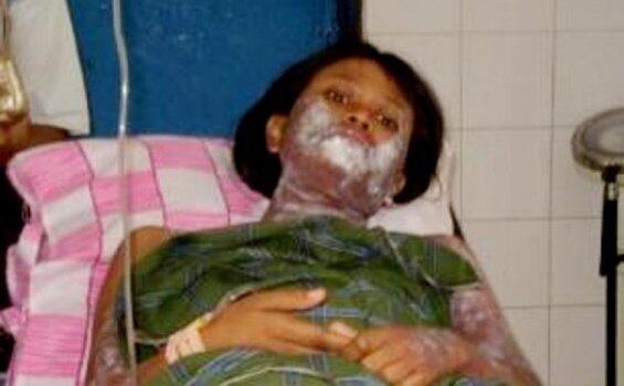 Kejam, Suami Tega Siram Air Keras Ke Wajah Mantan Istrinya