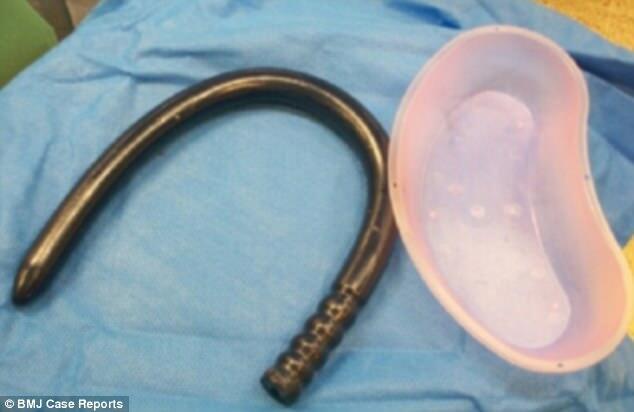 Horor, Dokter Keluarkan Seks Toy 3/4 Meter dari Anus Pria Inggris