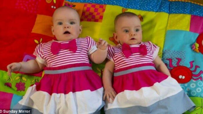 Unik! Proses Kelahiran Anak Kembar Asal Irlandia Ini Ajaib! Beda Usianya 87 Hari