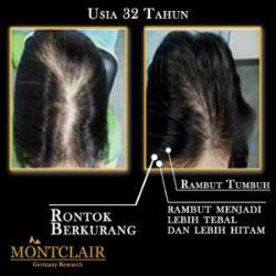 Montclair Hair Serum Mengatasi Kebotakan Kerontokan Rambut Garansi Pasti Tumbuh