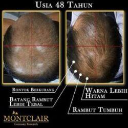 Montclair Hair Serum Mengatasi Kebotakan Kerontokan Rambut Garansi Pasti Tumbuh