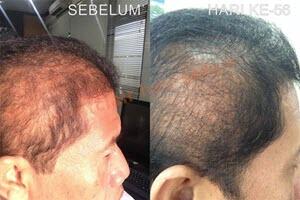 Montclair Hair Serum Mengatasi Kebotakan Kerontokan Rambut Garansi Pasti Tumbuh