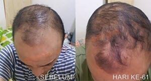 Montclair Hair Serum Mengatasi Kebotakan Kerontokan Rambut Garansi Pasti Tumbuh