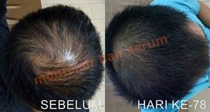 Montclair Hair Serum Mengatasi Kebotakan Kerontokan Rambut Garansi Pasti Tumbuh