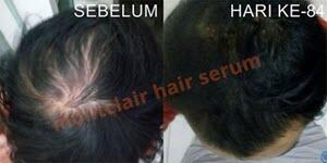 Montclair Hair Serum Mengatasi Kebotakan Kerontokan Rambut Garansi Pasti Tumbuh