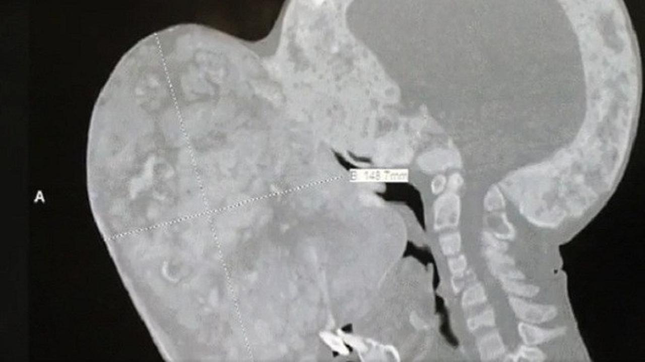Berawal dari Bintil, Tumor 4,5 Kg Tutupi Wajah Remaja 14 Tahun