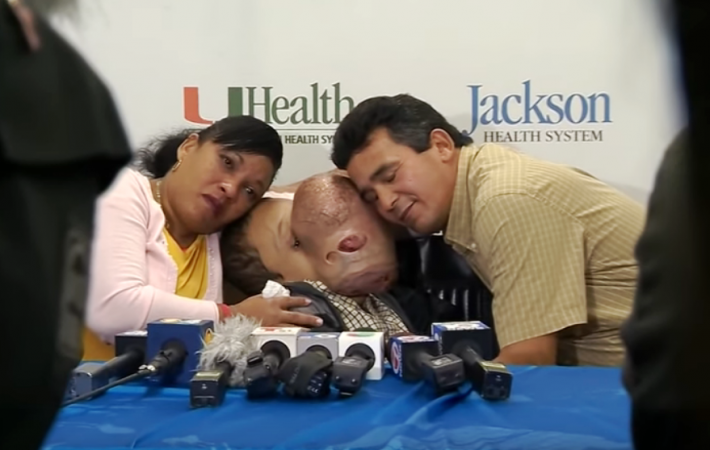 Berawal dari Bintil, Tumor 4,5 Kg Tutupi Wajah Remaja 14 Tahun