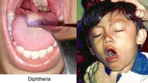 Waspada Difteri Di Tempat Wisata