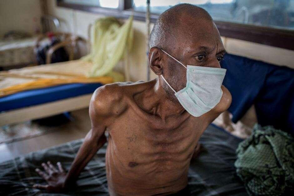 Indonesia Jadi Negara dengan Penderita Tuberkulosis Terbanyak Kedua di Dunia!