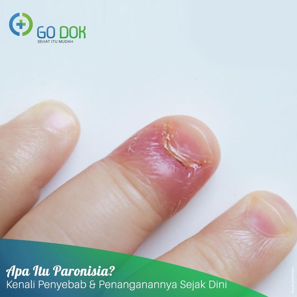 Mengenal Lebih Dekat Penyakit Paronikia