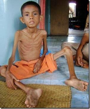 Bahaya, Ini 5 Dampak Jika Anak Kena Gizi Buruk