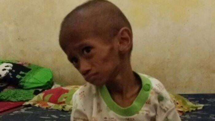 Tubuhnya Kurus, 194 Balita di Jakarta Utara Kekurangan Gizi