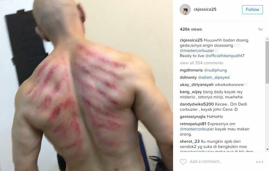 Gak Cuma Artis Indonesia, Ada Juga Artis Luar Negeri Yang Kerokan Kalau Lagi Sakit