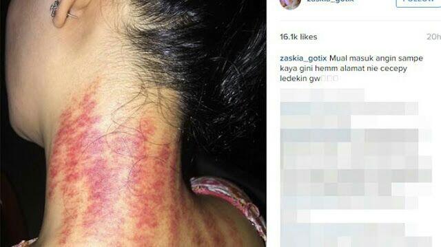 Gak Cuma Artis Indonesia, Ada Juga Artis Luar Negeri Yang Kerokan Kalau Lagi Sakit