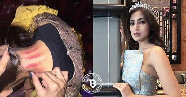Gak Cuma Artis Indonesia, Ada Juga Artis Luar Negeri Yang Kerokan Kalau Lagi Sakit