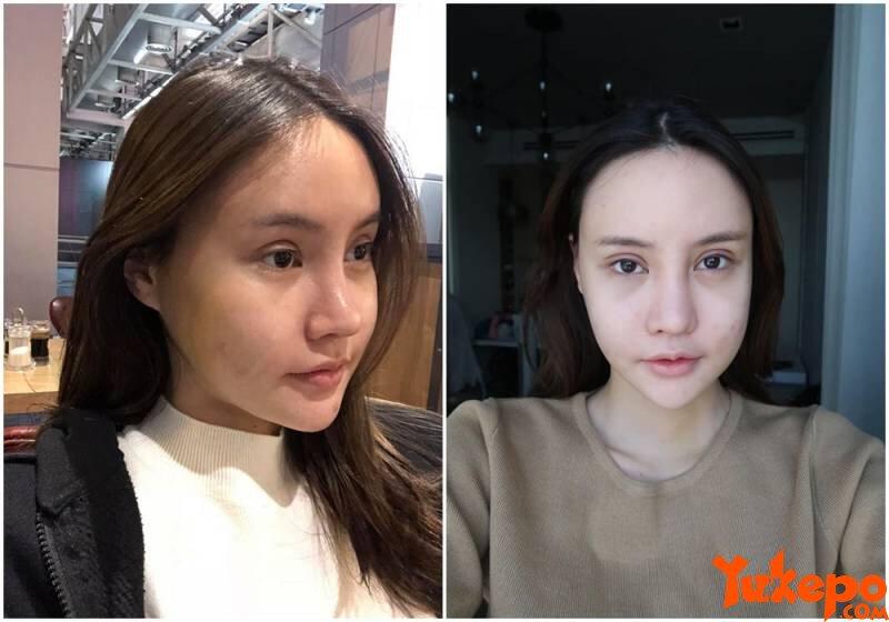 Nggak Langsung Cantik, Foto Wanita Setelah Operasi Plastik Ini Bikin Merinding Disko