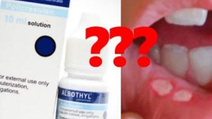Efek Samping Penggunaan Albothyl untuk Obati Sariawan, Ini Penjelasan Resmi BPOM
