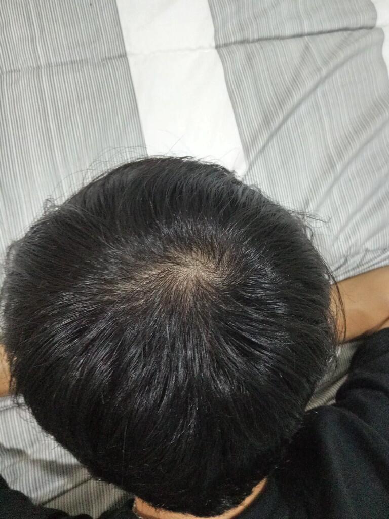 Rambut Gua Rontok Hampir Botak Page 212 KASKUS