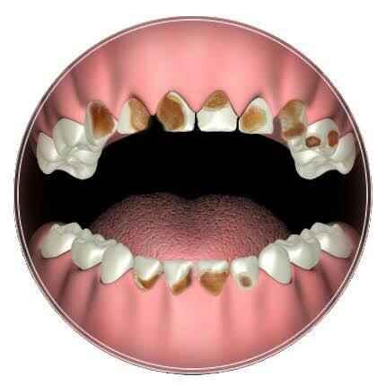 Ini resiko kesehatan kalo kamu pasang VENEER gigi bukan di dokter gigi