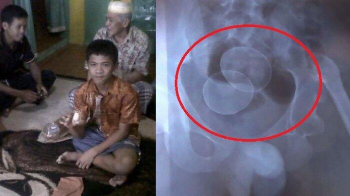 Fakta Bocah Bertelur di Sulsel, dari Telur Ayam sampai Jumlahnya yang 21 Butir