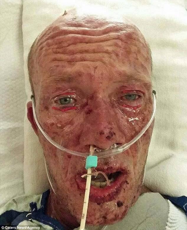 Efek Samping Antibiotik, Pria Ini Jadi Seperti Zombie dan Nyaris Meninggal, Kok Bisa?