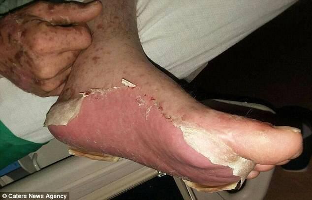 Efek Samping Antibiotik, Pria Ini Jadi Seperti Zombie dan Nyaris Meninggal, Kok Bisa?