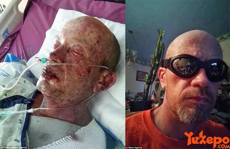 Efek Samping Antibiotik, Pria Ini Jadi Seperti Zombie dan Nyaris Meninggal, Kok Bisa?