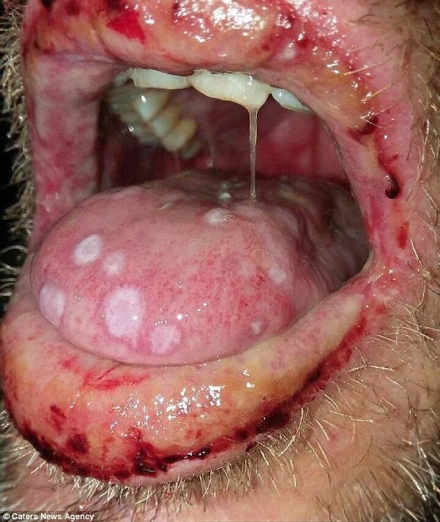Efek Samping Antibiotik, Pria Ini Jadi Seperti Zombie dan Nyaris Meninggal, Kok Bisa?