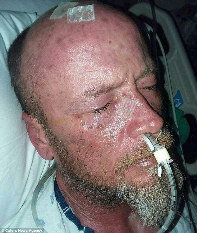 Efek Samping Antibiotik, Pria Ini Jadi Seperti Zombie dan Nyaris Meninggal, Kok Bisa?