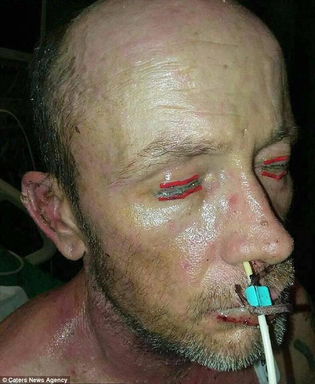 Efek Samping Antibiotik, Pria Ini Jadi Seperti Zombie dan Nyaris Meninggal, Kok Bisa?