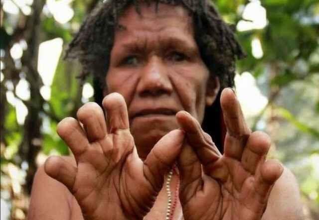 Tradisi Potong Jari Suku Dani, Bukti Kesetiaan Terhadap Keluarga