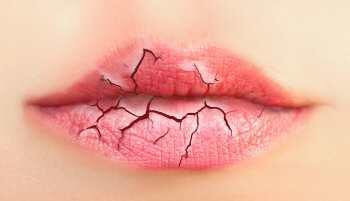 Cara Merawat Bibir Kering Dan Pecah Pecah Mengelupas. Cobain Yuk !