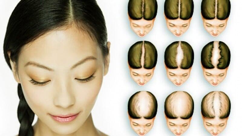 Berbagai Sebab Rambut Mudah Rontok