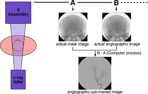 Mengenal "Terapi Cuci Otak" Digital Substraction angiography (DSA)