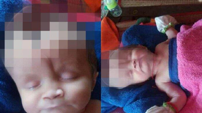 Orang Tua Panik Karena Anaknya Lahir dengan KeadaanTengkorak Tak Utuh