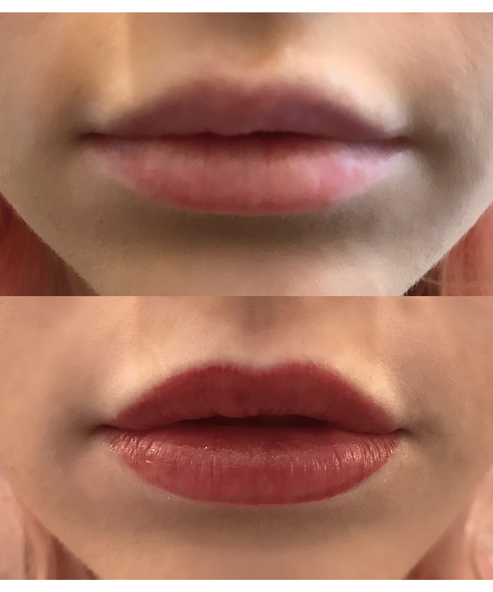Pakai Tattoo Lip KW, Bibir Wanita ini Alami Infeksi sampai Membengkak Parah