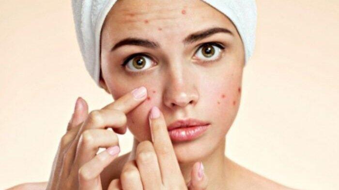 Mudah dan Murah, Inilah 6 Bahan Alami Hilangkan Bekas Jerawat dari Wajah