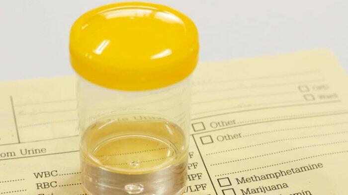 Penyakit Ini Picu Perubahan Warna Urine