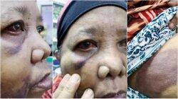 TKW Berusia 62 Tahun Ini Disiksa oleh Majikannya di Malaysia Hingga Tuli