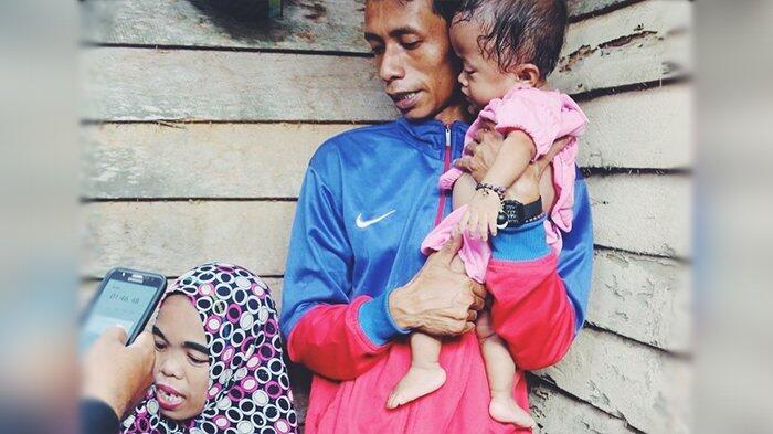Anak Buruh Parut Kelapa Ini Menderita Gizi Buruk