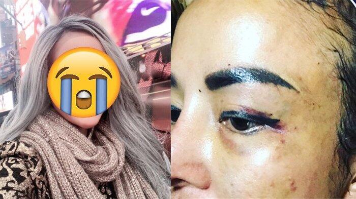 Wajah Cynthiara Alona Penuh Lebam, Ternyata Ini Pelakunya & Alasan Ia Dipukuli